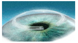 anelli corneale intrastromali (intacs)