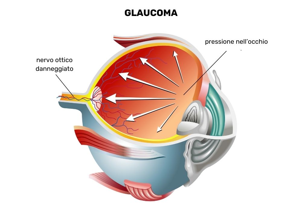 Grafica che mostra come un glaucoma agisce sull'occhio in termini di pressione e danneggiamento del nervo ottico.
